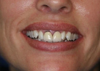Close-up of a smiling mouth showing slightly uneven and stained upper front teeth.