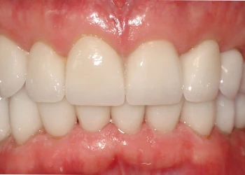 Close-up of a person's upper and lower front teeth and gums.