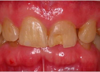 Close-up of upper front teeth with a chipped right central incisor and visible plaque on adjacent teeth.