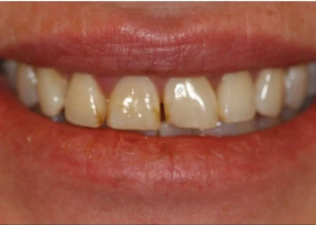 Close-up of a smile showing stained and chipped front teeth with discoloration.