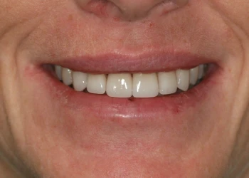 Close-up of a smiling mouth showing upper teeth with slightly visible lips and skin wrinkles.