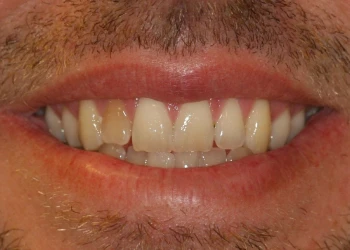 Close-up of a smiling man's mouth showing uneven and discolored upper front teeth.