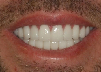 Close-up of a smiling mouth with white, well-aligned teeth and light facial hair around the lips.