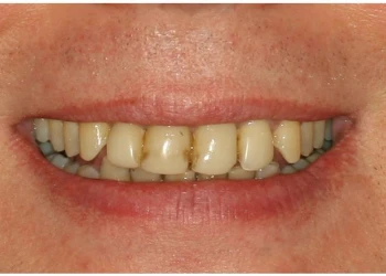 Close-up of a person's smile showing stained and uneven front teeth.