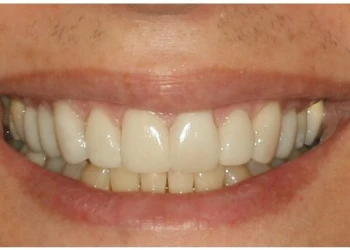 Close-up of a smiling mouth showing white, evenly aligned teeth.