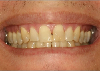 Close-up of a smile showing upper and lower teeth with slight gaps and yellowish tint.