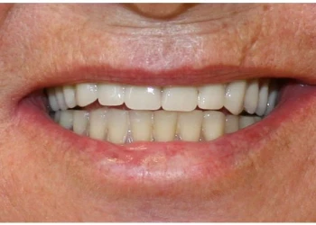 Close-up of a smiling mouth showing clean upper teeth and slightly discolored lower teeth.