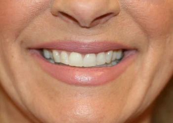 Close-up of a smiling person's mouth showing straight, white teeth and natural lip color.