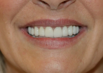 Close-up of a smiling mouth showing straight, white teeth and natural lip texture.