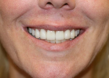 Close-up of a smiling mouth showing straight, white teeth and natural lips.