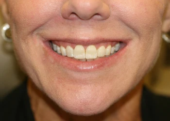 Close-up of a smiling person's mouth showing natural upper teeth and lips.
