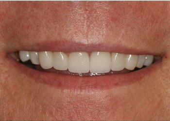 Close-up of a smiling mouth showing clean, white teeth.
