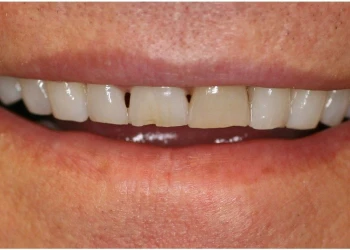 Close-up of a person's mouth showing upper front teeth with a chipped central incisor.