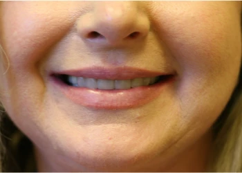 Close-up of a smiling woman's mouth and lower face showing teeth and lips.