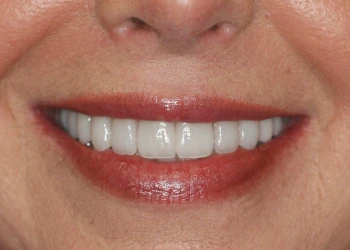 Close-up of a smiling mouth showing clean, white teeth and glossy red lipstick.