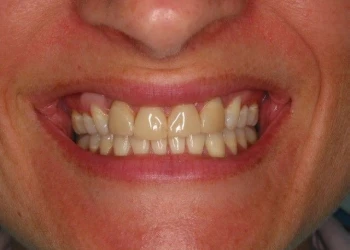Close-up of a person's mouth showing a smile with slightly uneven and yellowed teeth.