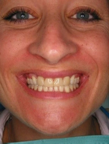 Close-up of a smiling woman's face showing her teeth with blue eyes and light skin.