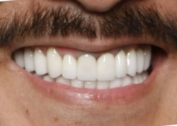 Close-up of a person's mouth showing white, straight teeth and a mustache.