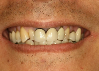 Close-up of a person's smile showing stained and misaligned teeth.