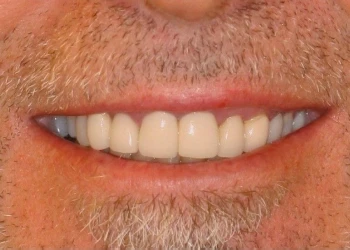 Close-up of a smiling mouth showing white teeth and light facial hair on the upper lip and chin.