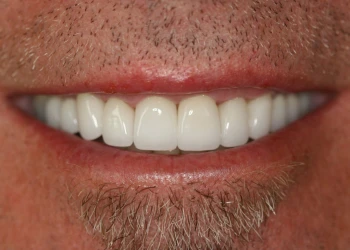 Close-up of a man’s mouth smiling, showing white teeth and a goatee.