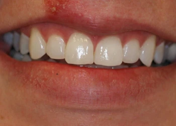 Close-up of a closed smile showing upper front teeth and lips with slight skin redness above the lip.