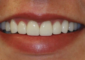Close-up of a smiling mouth showing straight, white teeth and natural lips.