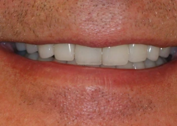 Close-up of a person's mouth showing clean white teeth with a slight smile.
