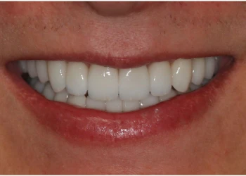 Close-up of a smiling mouth showing straight, white teeth with full upper and lower teeth visible.