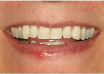 Close-up of a person’s mouth smiling, showing clean white teeth and slightly chapped lower lip.