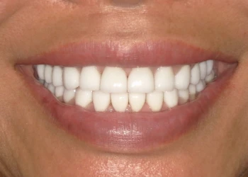 Close-up of a person smiling showing clean, white teeth and pink lips.