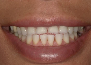 Close-up of a smiling mouth showing teeth with mild discoloration and slight spacing between lower front teeth.