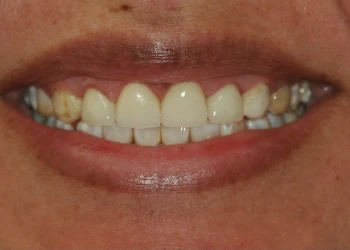 Close-up of a smile showing upper teeth with some discoloration and gaps.