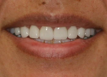 Close-up of a person's smile showing clean white teeth with a small gap between front teeth.
