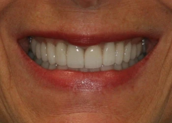 Close-up of a person's smile showing clean, well-aligned white teeth and natural lips.