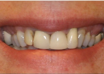 Close-up of a smile showing stained and misaligned teeth with gaps.