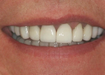 Close-up of a smiling mouth showing clean and well-aligned teeth.