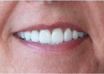 Close-up of a smile showing white, well-aligned teeth.