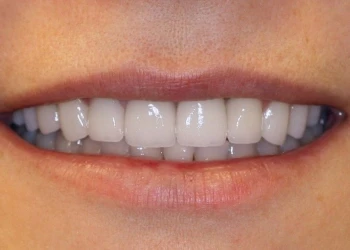 Close-up of a person smiling showing clean, straight white teeth and closed lips.