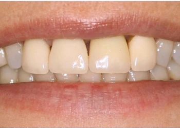 Close-up of a person's mouth showing upper front teeth with slight discoloration and small gaps.