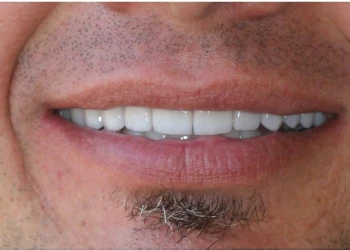 Close-up of a smiling man's mouth showing clean white teeth, light stubble, and a small patch of hair below the lower lip.