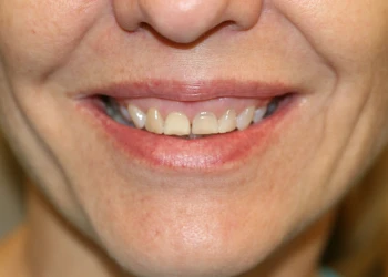 Close-up of a person's mouth smiling, showing slightly uneven upper front teeth.