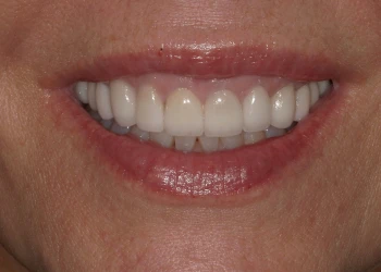 Close-up of a smiling mouth showing clean, even, and white teeth with natural gums.