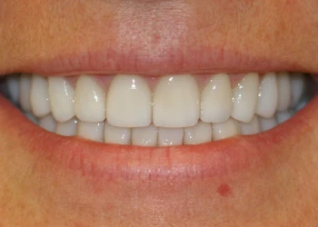 Close-up of a smiling mouth showing straight, white teeth.