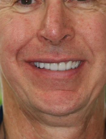 Close-up of a smiling man's lower face showing bright, even white teeth.