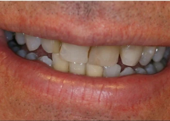 Close-up of a person's mouth showing slightly yellowed and misaligned upper and lower teeth.