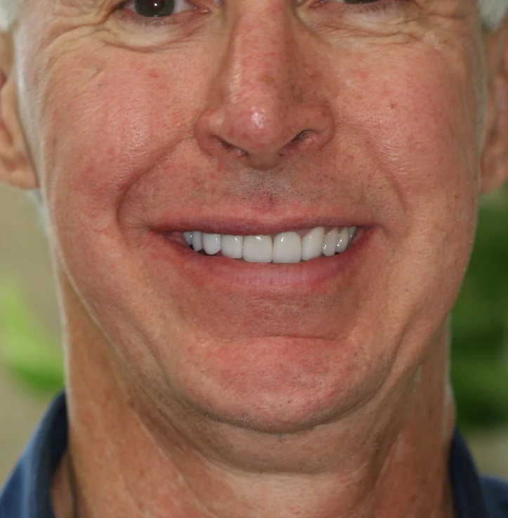 Close-up of a smiling middle-aged man's lower face showing white teeth, light skin with freckles, and part of a blue collar.