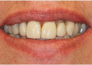 Close-up of a person's mouth showing slightly uneven teeth with a natural lip color.