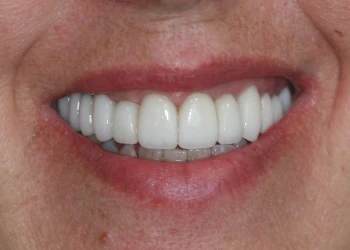 Close-up of a person's smile showing clean, white teeth.