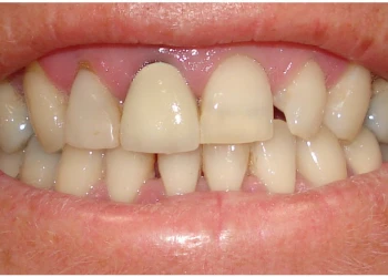 Close-up of a person's mouth showing teeth with gaps and uneven alignment.